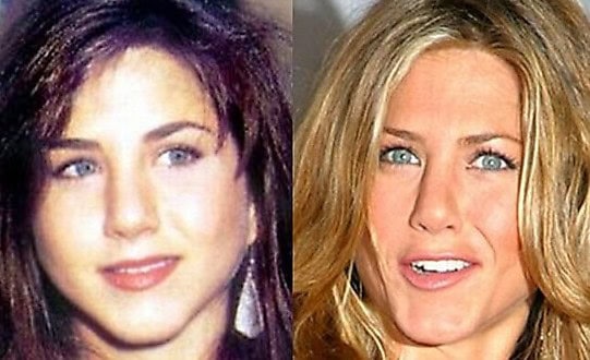 before after plastic surgery aniston