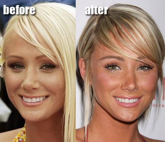 celebrities before after plastic surgery