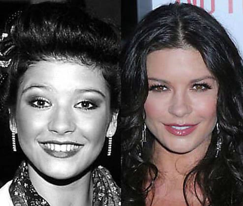 celebrity plastic surgeruy before after photos