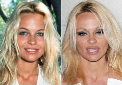 pamela anderson before plastic surgery