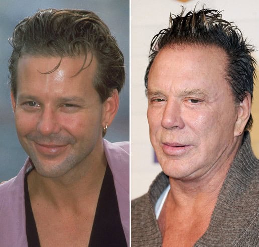 worst celebrity plastic surgery